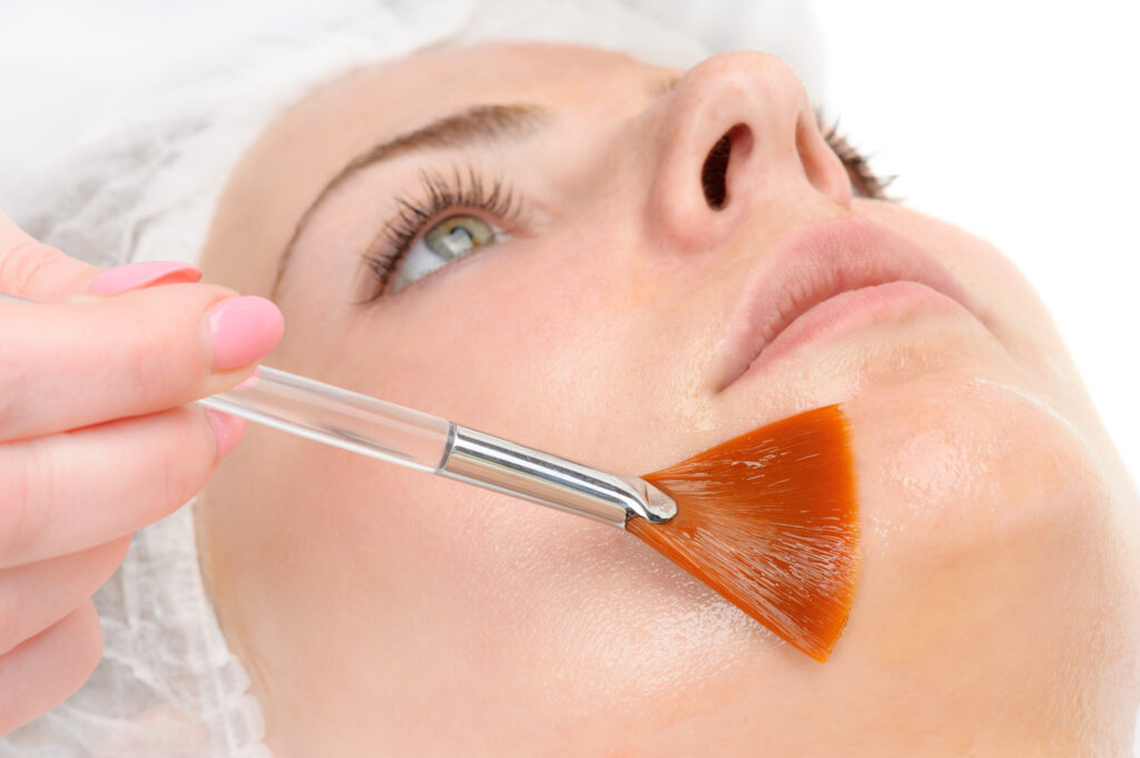 chemical skin peel